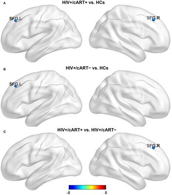 Altered gray matter structural covariance networks in drug-naïve and treated early HIV-infected individuals